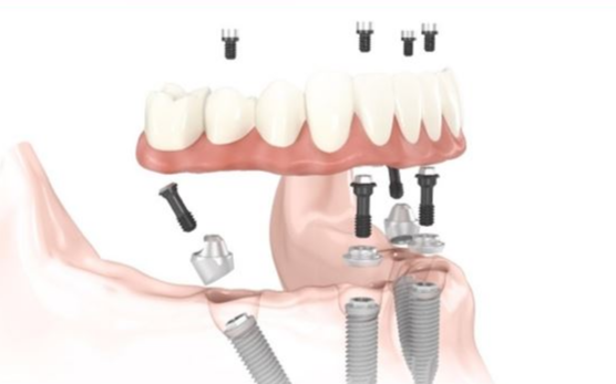 大天使植牙專科 周啓誠醫生專欄22——All-on-4到底是什麽？